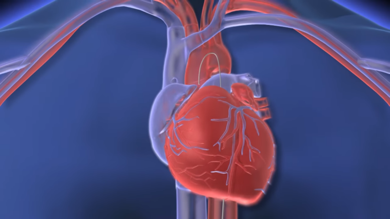 A 3D Image Showing a Catheter Inserted Into the Heart’s Blood Vessels for A Cardiac Procedure