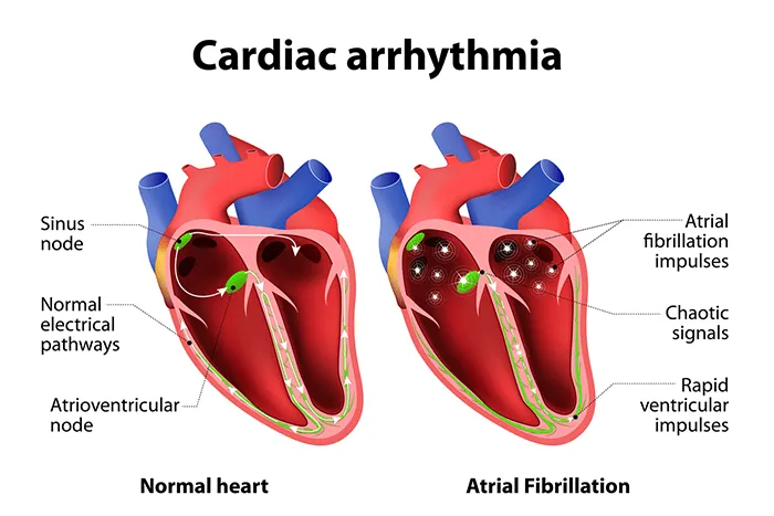 arrythmia