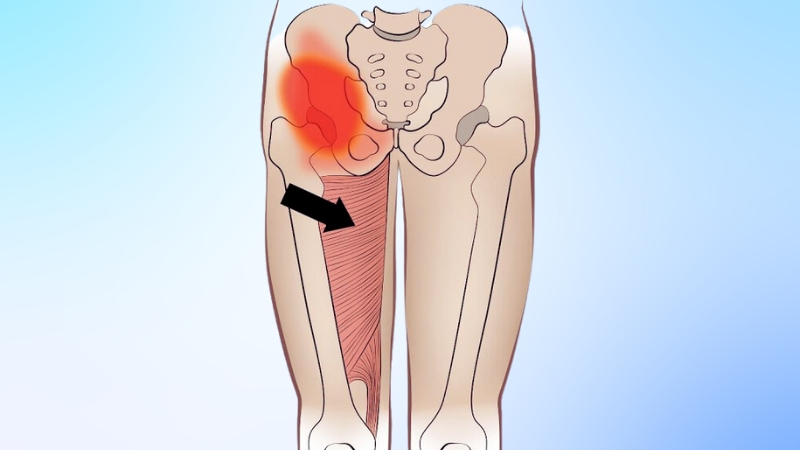 Illustration Highlighting Chronic Groin Pain in A Woman's Hip and Thigh Area