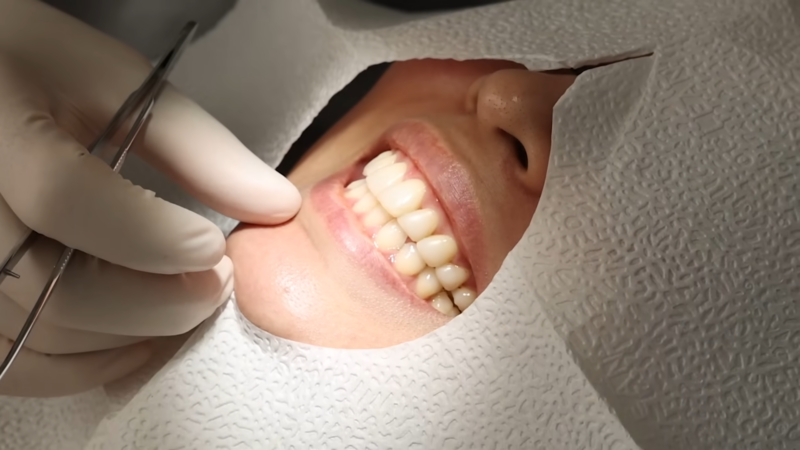 Application of High-Quality Veneers on A Patient's Teeth in Dubai