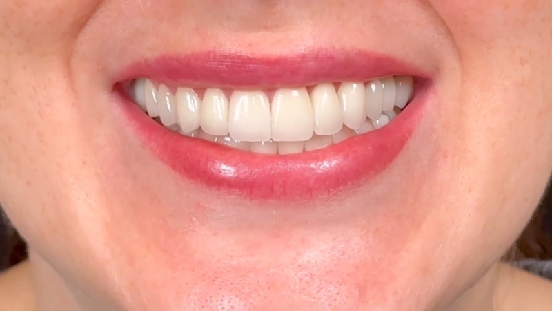 A Close-Up of A Person’s Bright Smile Showcasing Porcelain Veneers