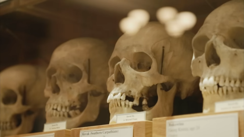 Skulls Displayed in The Mütter Museum in Philadelphia