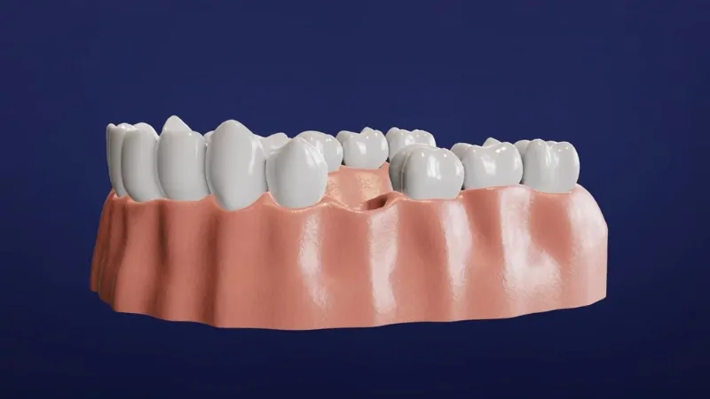 Visual Representation of A Dental Implant Placement Showcasing Tooth Restoration