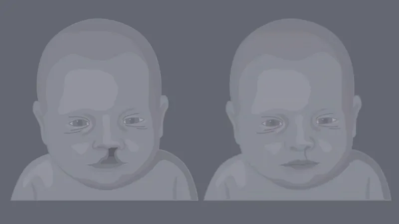 Illustration comparing a baby with and without a cleft lip, highlighting one of the most common birth defects