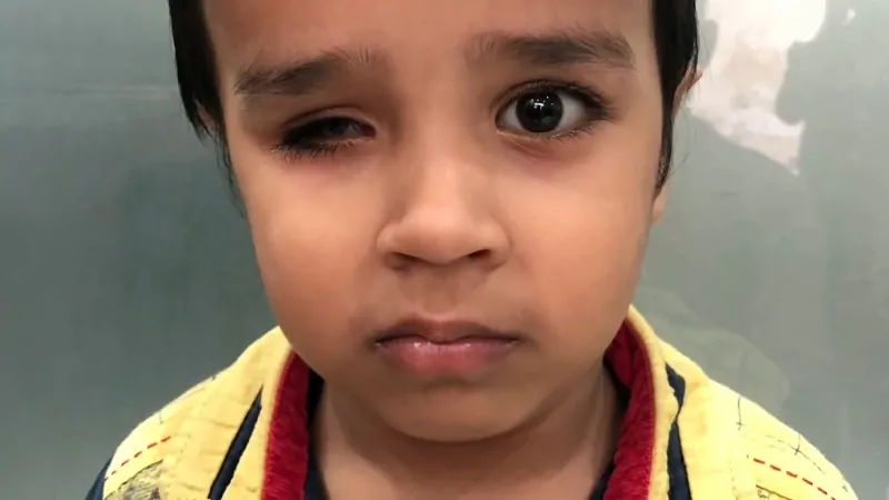 A young child with a visible eye defect affecting one eye