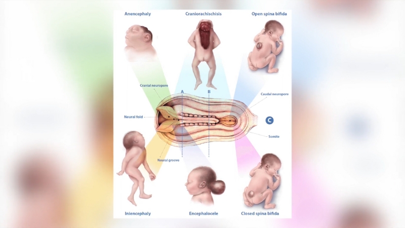Diagram showing different types of neural tube defects in babies