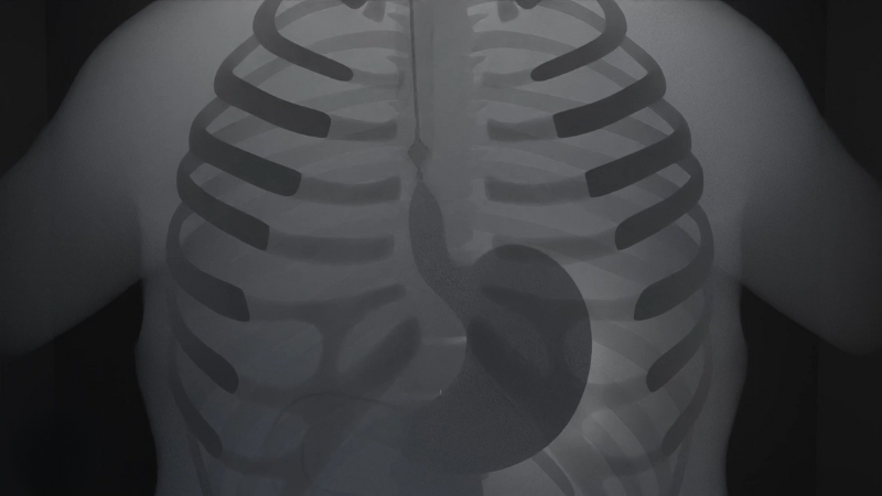 Medical illustration showing the digestive tract inside the ribcage, highlighting congenital stomach and intestinal defects