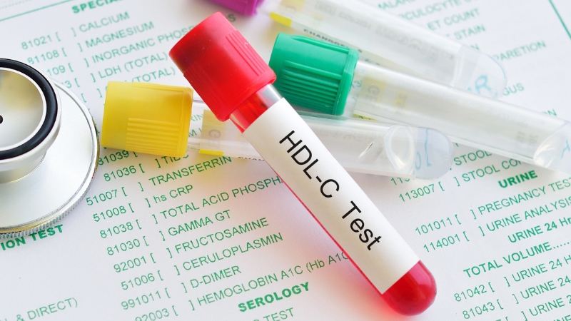 Blood sample labeled HDL-C test placed on lab results, highlighting non-HDL cholesterol as a key predictor of heart health