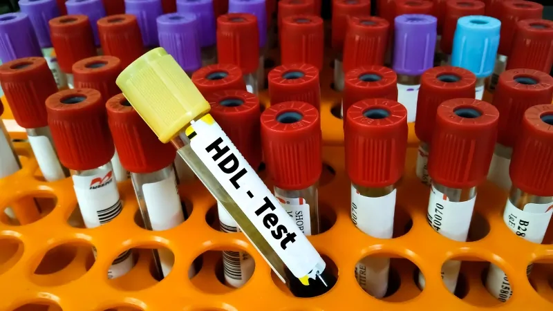 Blood sample labeled HDL test