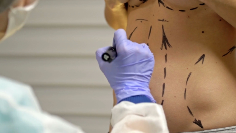A surgeon marking a patientโs torso in preparation for a cosmetic procedure