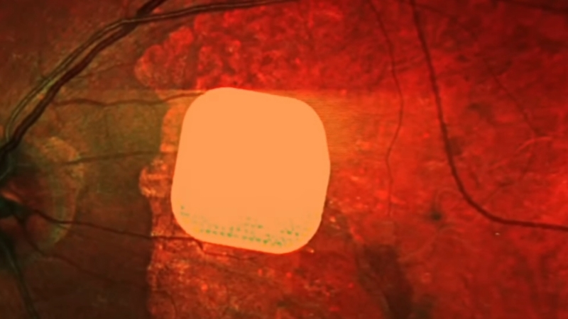 A tiny retinal chip sits beneath the retina during a vision restoration procedure