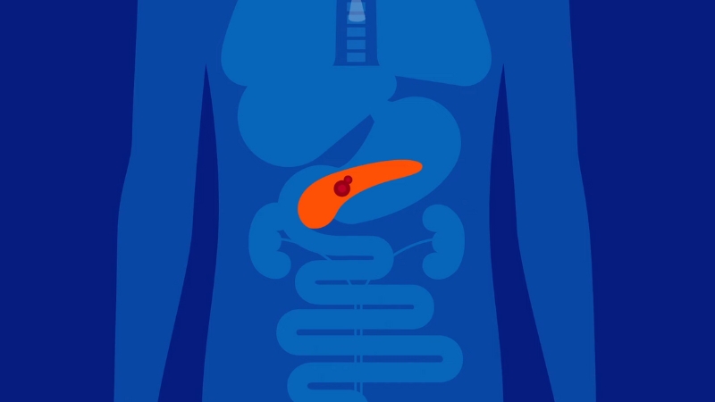 Illustration showin the pancreas highlighted inside the human body to explain why pancreatic cancer proves hard to treat