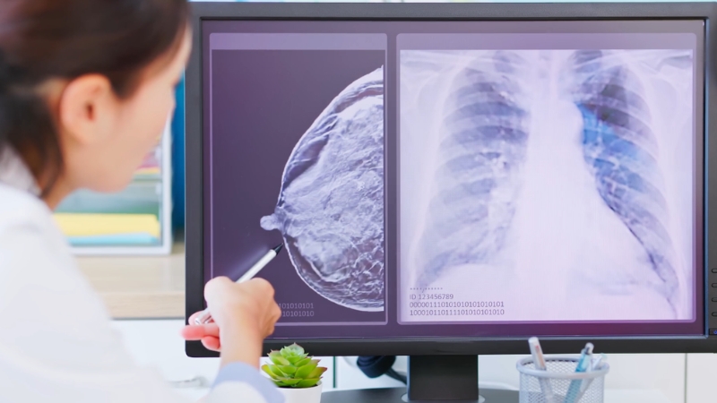 Doctor reviewing breast scan and chest X-ray images on a computer monitor