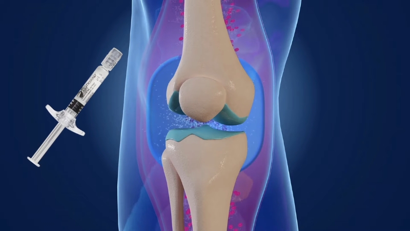 Illustration of a knee joint with a syringe showing a hyaluronic acid injection for osteoarthritis treatment