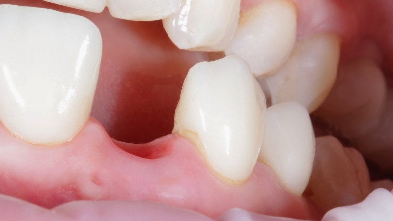 Close-up of a missing tooth gap in the gums illustrating challenges for tooth regrowth treatment