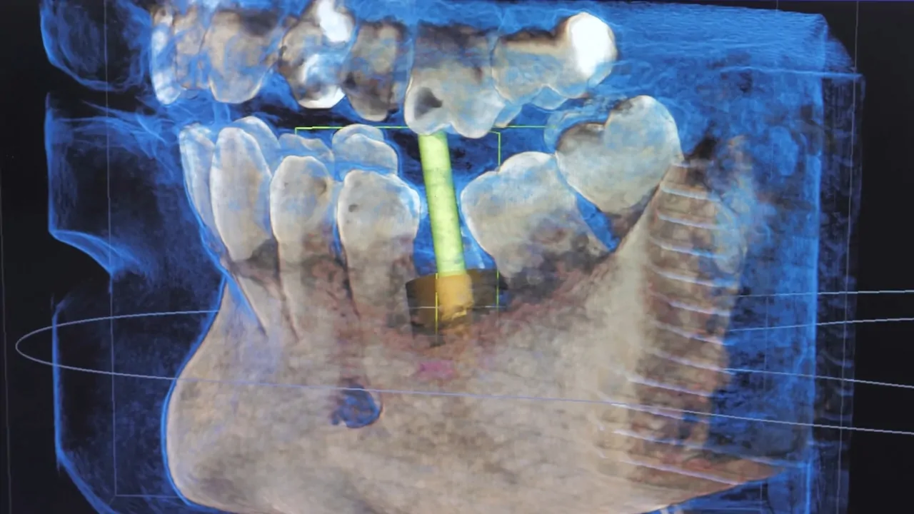 Dental X-ray of a jaw with a dental implant highlighting area relevant to tooth regrowth treatment