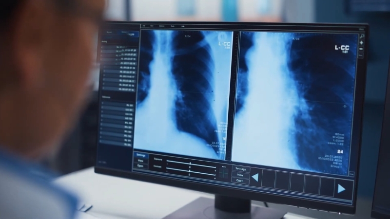 Doctor examining chest X-ray images on a computer screen in a hospital setting