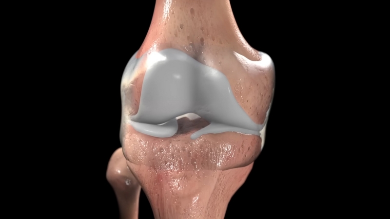 Close-up medical illustration of a knee joint showing worn cartilage between the bones