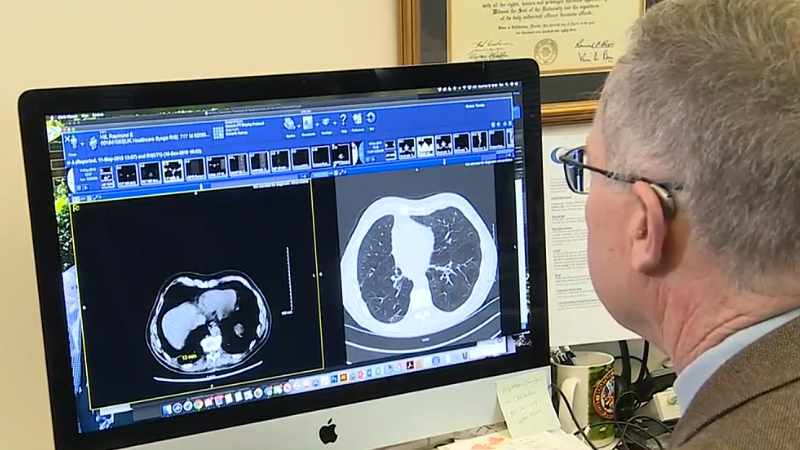 Doctor reviewing lung CT scans on a computer screen