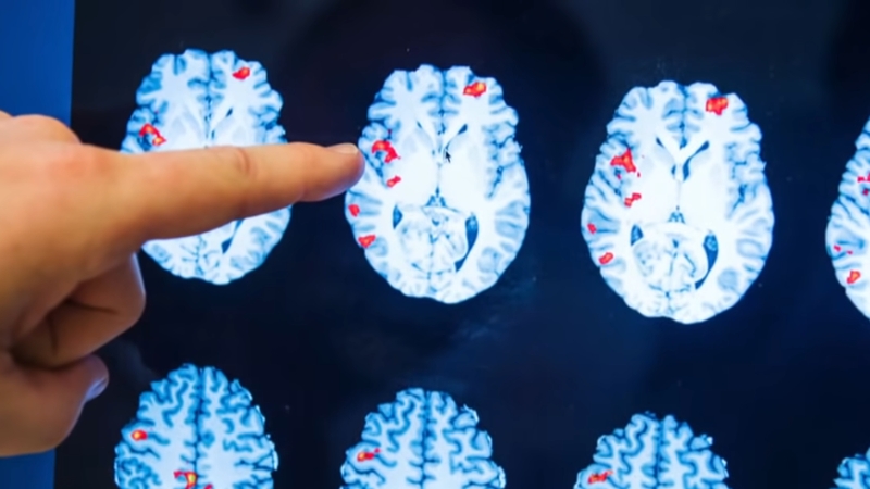 Close-up of brain scans showing activity patterns after the heart stops