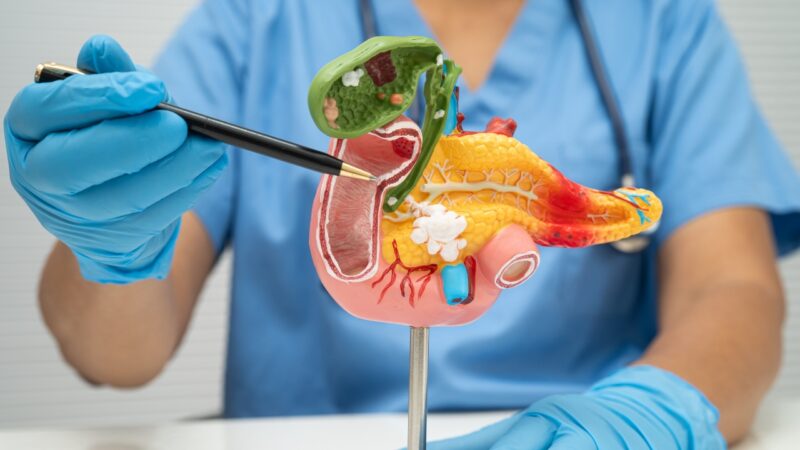 Doctor pointing to a pancreas model during a medical explanation of pancreatic cancer