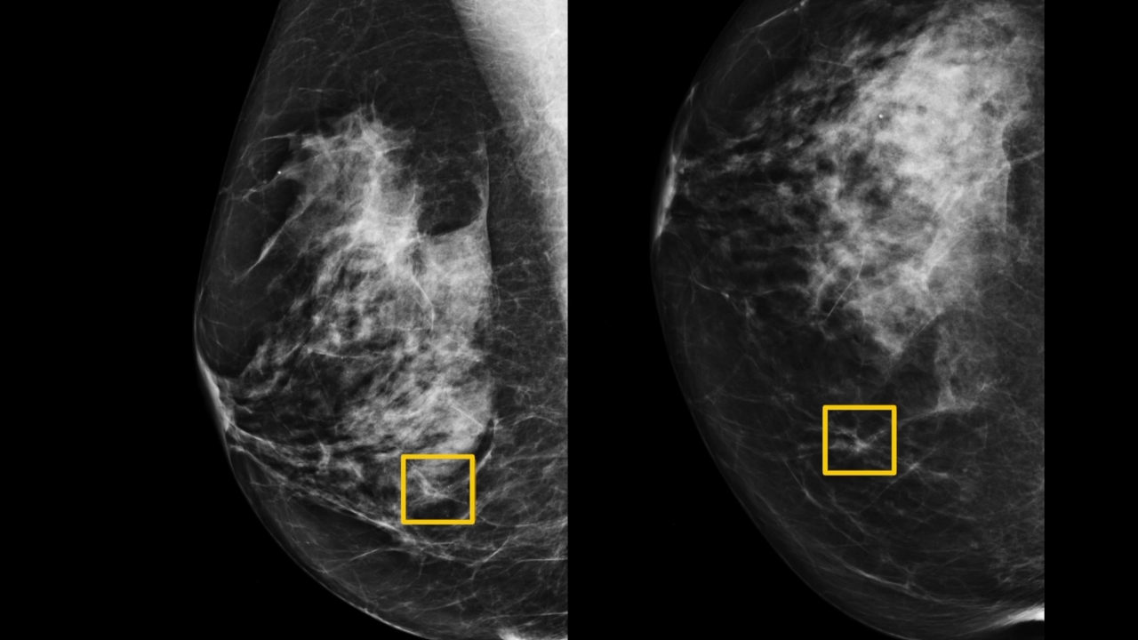 Mammogram images with highlighted areas used for breast cancer analysis