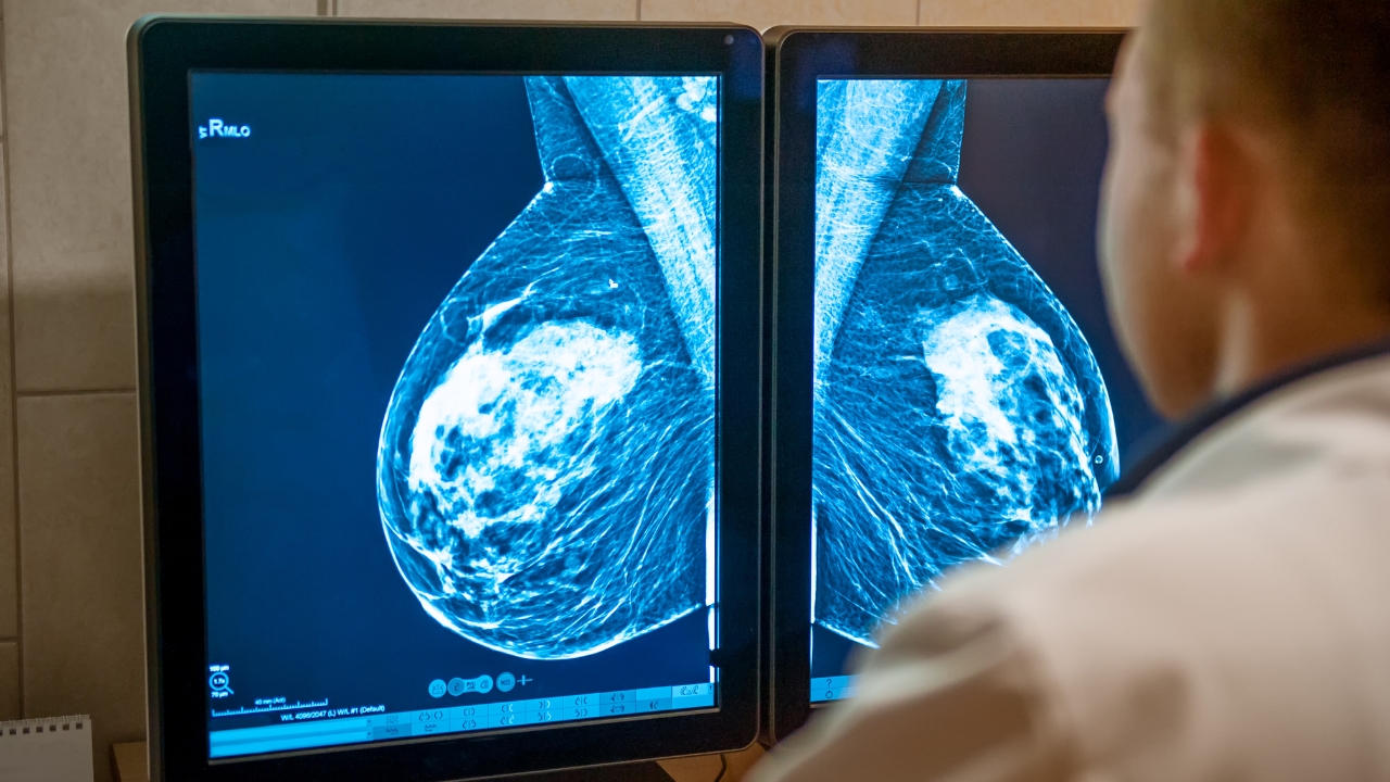 Doctor reviews breast scan images on dual monitors during a mammogram analysis.
