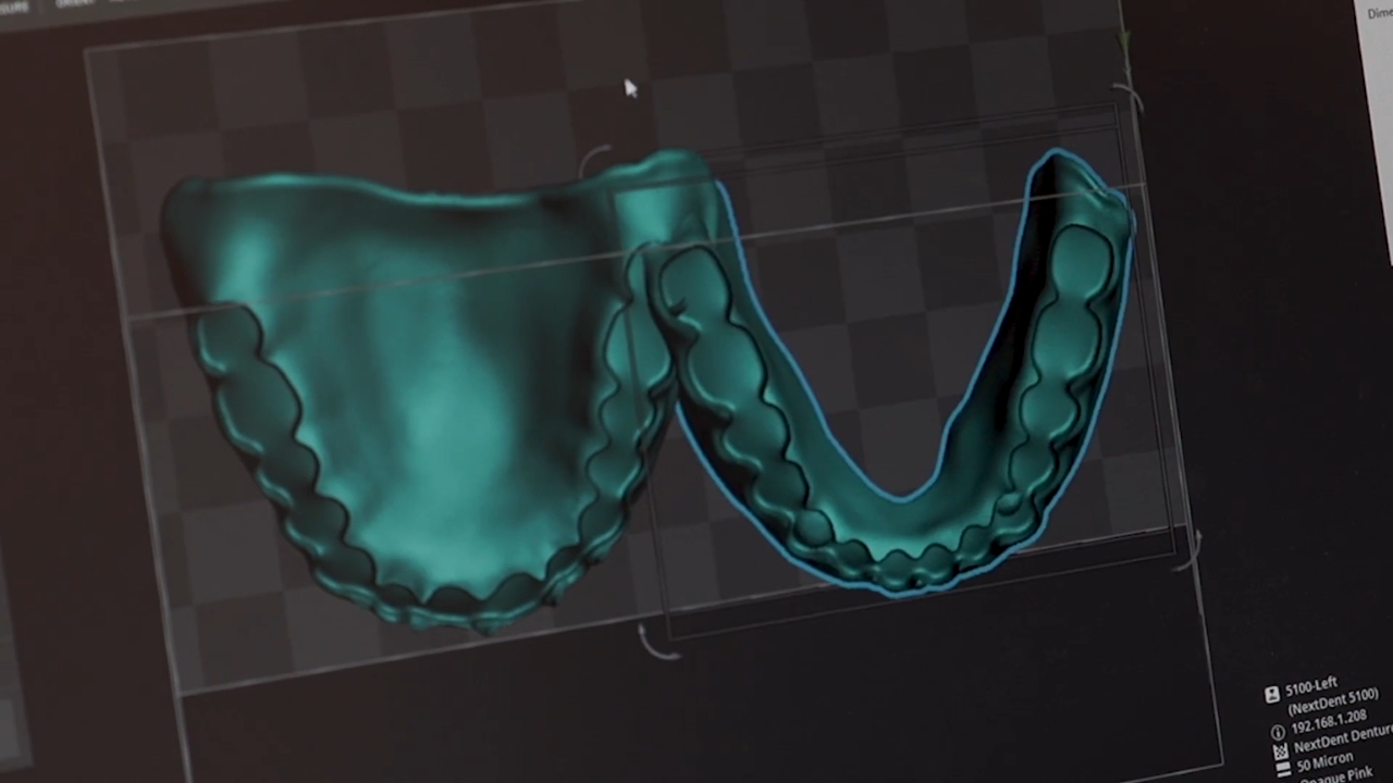 A digital denture design is prepared on screen before 3D printing