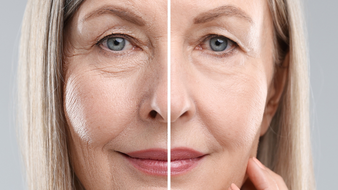 Before-and-after portrait of an older woman with smoother skin after collagen treatment