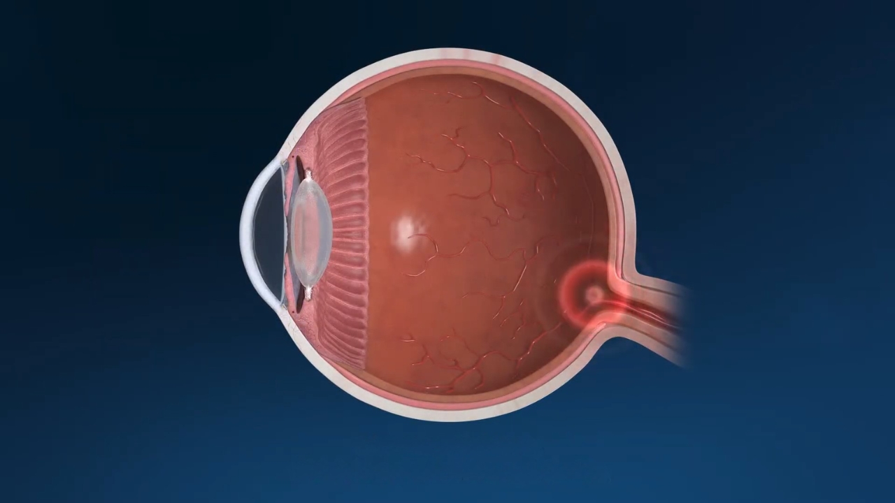 Cross-section illustration of a human eye with the optic nerve highlighted