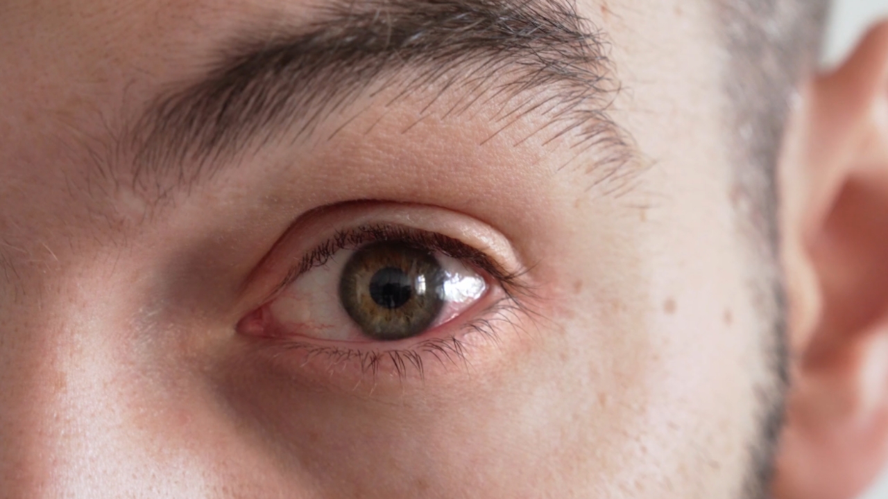 Close-up of a man's red, irritated eye