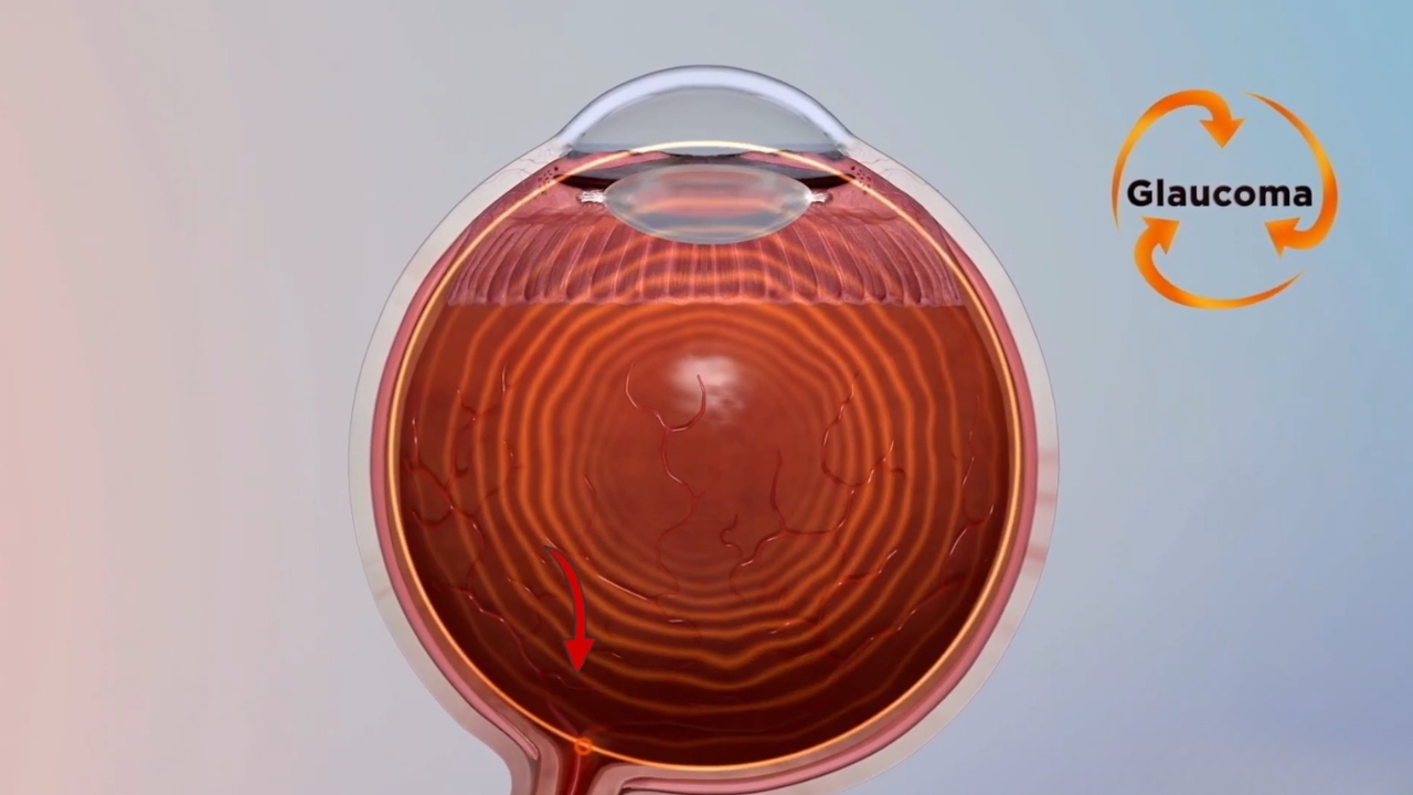 Illustration of glaucoma inside the human eye