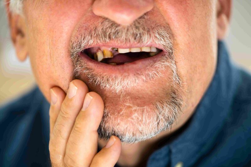 Close-up of an older man with missing and decayed teeth touching his cheek, showing visible signs of poor dental health.