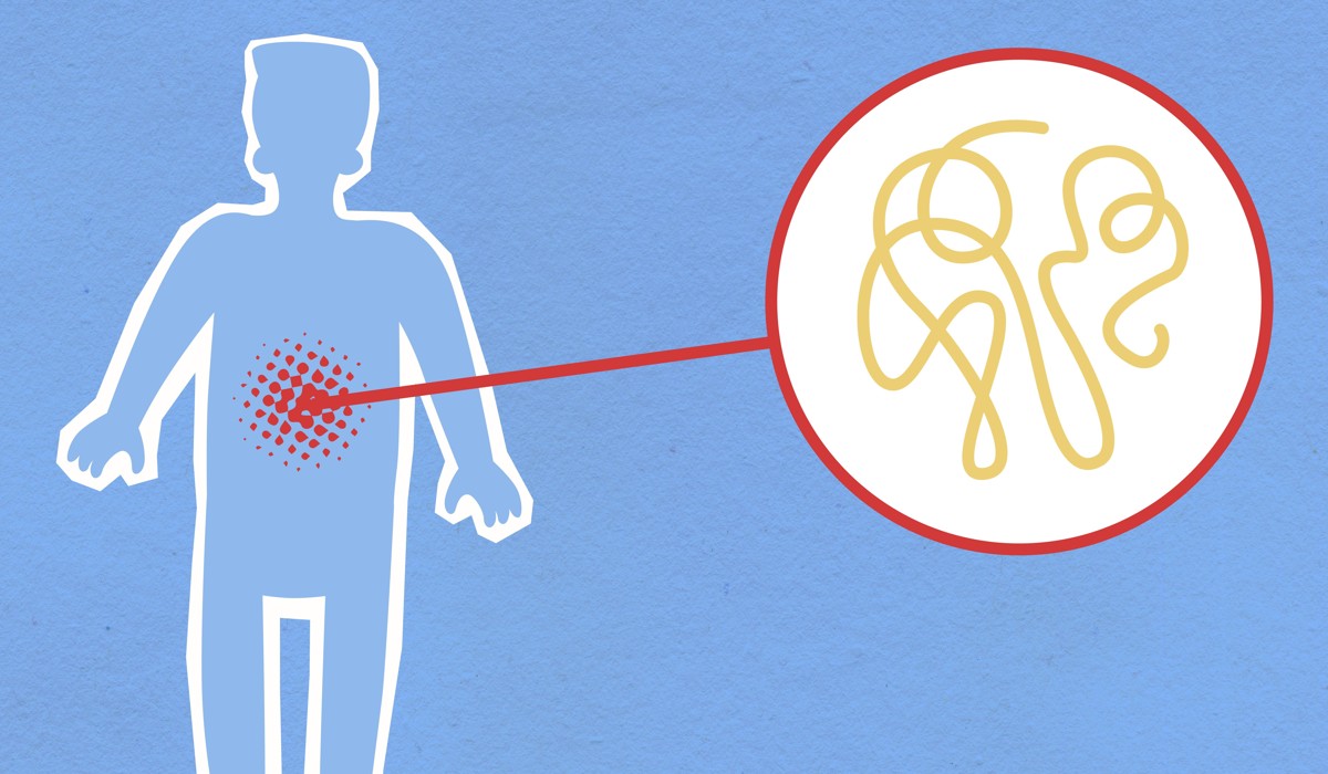 WHO Cancer Study Finds 12% of New Cases Linked to Infections